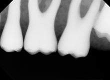 Load image into Gallery viewer, Tuxedo Imaging LLC Dental Digital Intraoral X-Ray Sensor Size 2