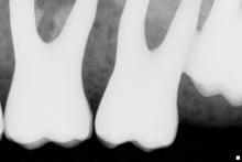Load image into Gallery viewer, Sirona Schick Elite CDR Dental Digital Intraoral X-Ray Sensor Size 1