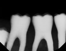 Load image into Gallery viewer, Dexis Titanium Dental Intraoral X-Ray Sensor Size 2