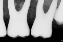 Load image into Gallery viewer, Schick CDR Elite Dental Intraoral X-Ray Sensor Size 1