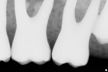 Load image into Gallery viewer, Schick CDR Elite Dental Intraoral X-Ray Sensor Size 1