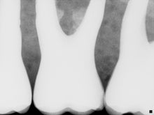 Load image into Gallery viewer, Schick CDR Elite Dental Intraoral X-Ray Sensor Size 0