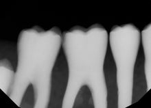 Load image into Gallery viewer, Dexis IXS Dental Intraoral X-Ray Sensor Size 2