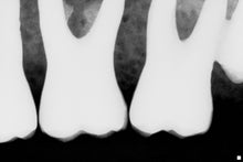 Load image into Gallery viewer, Schick CDR Elite Digital Imaging Intraoral X-Ray Sensor Size 1