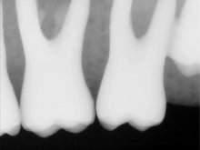 Load image into Gallery viewer, Kodak RVG 6100 Dental Intraoral X-Ray Sensor Size 1