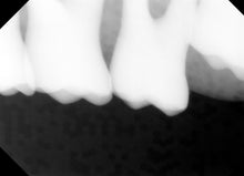 Load image into Gallery viewer, Tuxedo Digital Imaging Intraoral X-Ray Sensor Size 2