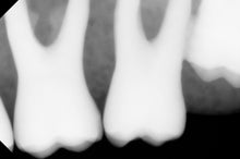 Load image into Gallery viewer, Dentimax Dream Dental Intraoral X-Ray Sensor Size 1