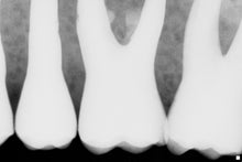 Load image into Gallery viewer, Schick CDR Elite Dental Digital Imaging Intraoral X-Ray Sensor Size 1