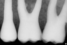 Load image into Gallery viewer, Schick CDR Elite Digital Imaging Dental Intraoral X-Ray Sensor Size 1