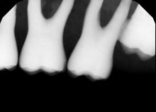 Load image into Gallery viewer, Gendex GXS-700 Dental Intraoral X-Ray Sensor Size 1