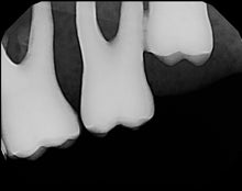 Load image into Gallery viewer, Carina Dental Intraoral X-Ray Sensor Size 1