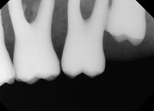 Load image into Gallery viewer, XDR Digital Imaging Intraoral X-Ray Sensor Size 2