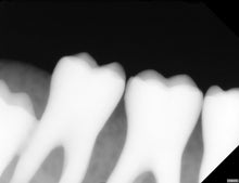 Load image into Gallery viewer, Acteon SOPIX 2 Dental Digital X-Ray Sensor Size 2 Intraoral Imaging