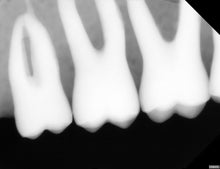 Load image into Gallery viewer, Acteon SOPIX 2 Dental Digital X-Ray Sensor Size 2 Intraoral Imaging