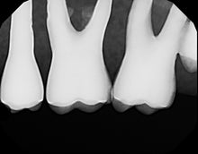 Load image into Gallery viewer, Dexis Platinum Digital Dental X-Ray Sensor Size 2 PerfectSize Direct USB 64bit