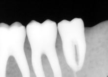 Load image into Gallery viewer, Sirona Schick 33 Dental Intraoral X-Ray Sensory Size 1