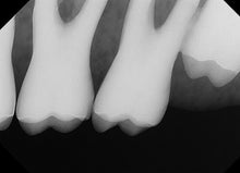 Load image into Gallery viewer, DentiMax Dream Sensor Size 2 Digital Dental X-Ray Sensor