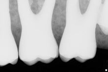 Load image into Gallery viewer, Sirona Schick CDR Elite Size 1 Digital Intraoral X-Ray Dental Sensor