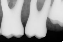 Load image into Gallery viewer, NEW UNUSED Sirona Schick 33 Digital Dental X-Ray Sensor Size 1 Anterior Pedo