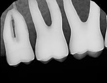 Load image into Gallery viewer, Dexis Platinum Dental Intraoral X-Ray Sensor Size 2