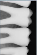 Load image into Gallery viewer, Sirona Schick 33 Size 1 Digital Dental Intraoral X-Ray Sensor