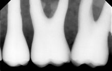Load image into Gallery viewer, Gendex eHD Visualix Dental Intraoral X-Ray Sensor Size 1
