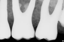 Load image into Gallery viewer, Sirona Schick Elite CDR Dental Digital Intraoral X-Ray Sensor Size 1
