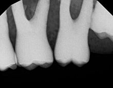 Load image into Gallery viewer, Gendex GXS-700 Dental Digital Intraoral X-Ray Sensor Size 1
