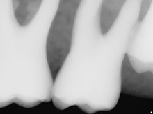 Load image into Gallery viewer, Sirona Schick 33 Dental Intraoral X-Ray Sensor Size 0
