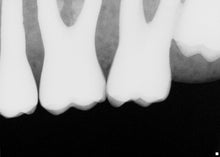 Load image into Gallery viewer, Schick CDR Elite Digital Imaging Intraoral X-Ray Sensor Size 1
