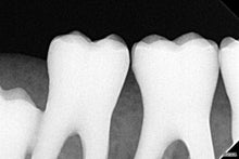 Load image into Gallery viewer, Acteon SoPix 2 Dental Intraoral X-Ray Sensor Size 1
