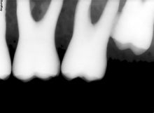 Load image into Gallery viewer, Suni SuniRay 2 Dental Intraoral X-Ray Sensor Size 2
