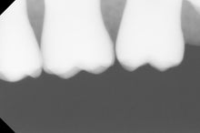 Load image into Gallery viewer, Suni SuniRay 2 Dental Intraoral X-Ray Sensor Size 1
