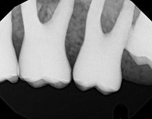Load image into Gallery viewer, Dexis Titanium Dental Intraoral X-Ray Sensor Size 2

