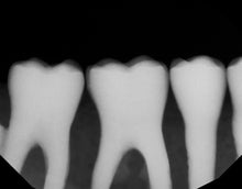 Load image into Gallery viewer, Dexis Titanium Dental Intraoral X-Ray Sensor Size 2
