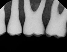 Load image into Gallery viewer, Dexis Titanium Dental Intraoral X-Ray Sensor Size 2
