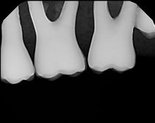 Load image into Gallery viewer, Carina Dental Intraoral X-Ray Sensor Kit Size 1
