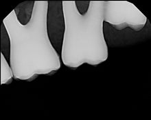 Load image into Gallery viewer, Carina Dental Intraoral X-Ray Sensor Size 1
