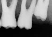 Load image into Gallery viewer, Schick CDR 2000 Size 2 Digital Dental Intraoral X-Ray Sensor Kit
