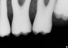 Load image into Gallery viewer, Schick CDR 2000 Size 2 Digital Dental Intraoral X-Ray Sensor Kit
