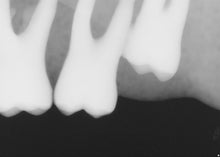 Load image into Gallery viewer, Sirona Schick 33 Dental Intraoral X-Ray Sensor Size 1
