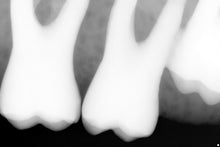 Load image into Gallery viewer, Sirona Schick 33 Dental Intraoral X-Ray Sensor Size 1
