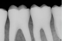 Load image into Gallery viewer, Sirona Schick CDR Elite Dental Digital X-Ray Sensor Size 1
