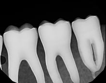 Load image into Gallery viewer, Dexis Platinum Digital Dental X-Ray Sensor Size 2 PerfectSize Direct USB 64bit
