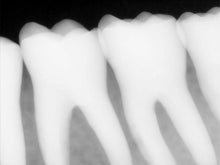 Load image into Gallery viewer, Carestream Kodak RVG 6100 Size 1 Dental Sensor
