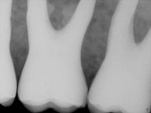 Load image into Gallery viewer, Sirona Schick CDR Elite Size 0 Digital Intraoral X-Ray Dental Sensor
