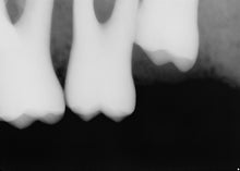 Load image into Gallery viewer, NEW UNUSED Sirona Schick 33 Digital Dental X-Ray Sensor Size 2 USB Interface
