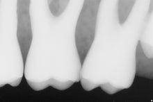 Load image into Gallery viewer, Sirona Schick 33 Dental Intraoral X-Ray Sensor Size 1

