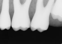 Load image into Gallery viewer, Sirona Schick 33 Dental Intraoral X-Ray Sensor Size 2

