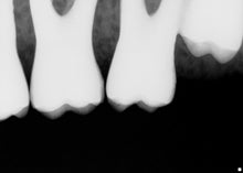Load image into Gallery viewer, Schick CDR Elite Size 2 Digital Dental Intraoral X-Ray Sensor Kit
